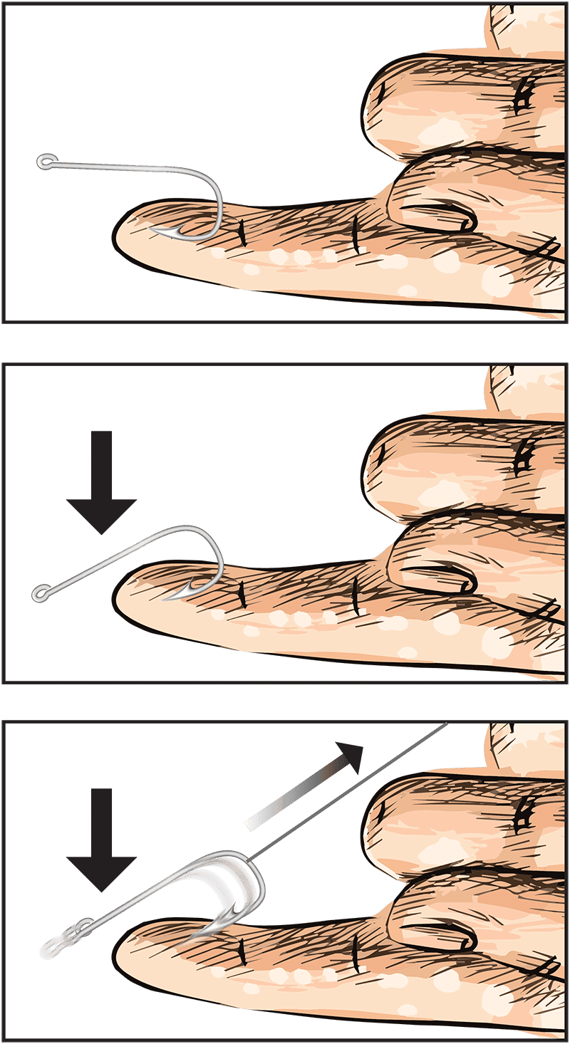 image_illustration of fish hook removal
